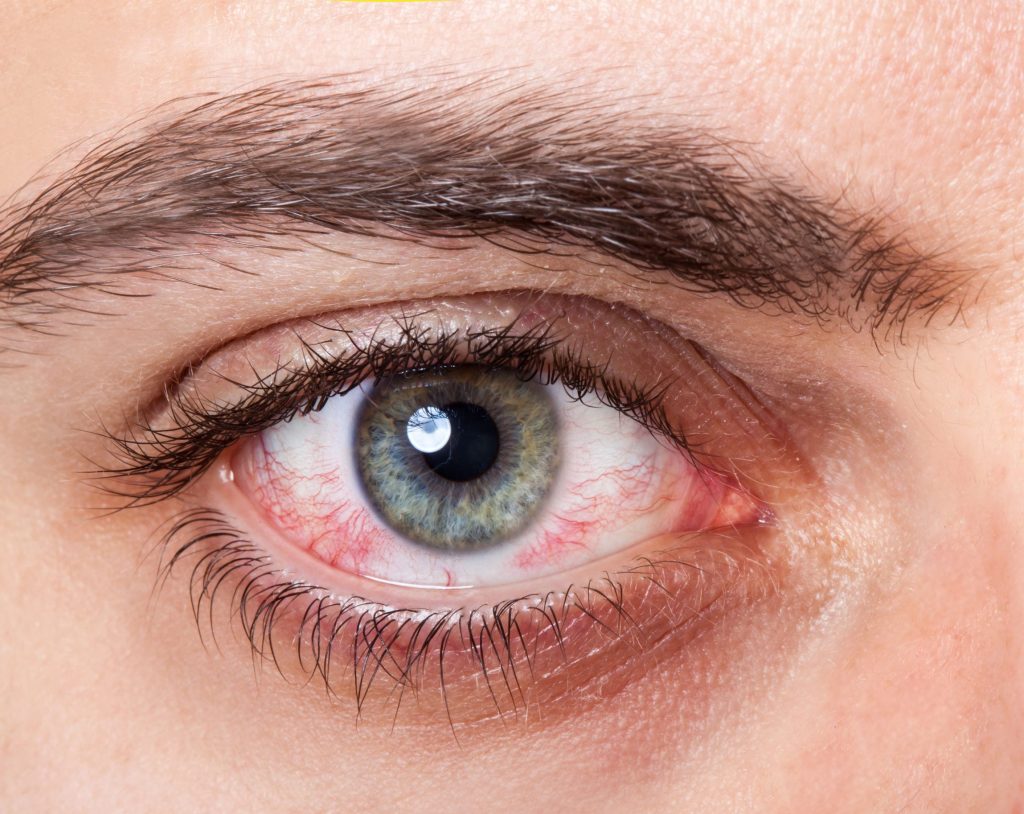 redness of eye